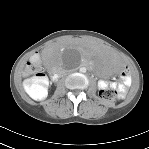 Abdominal desmoid tumor (Radiopaedia 41007-43740 Axial C+ portal venous phase 33).png