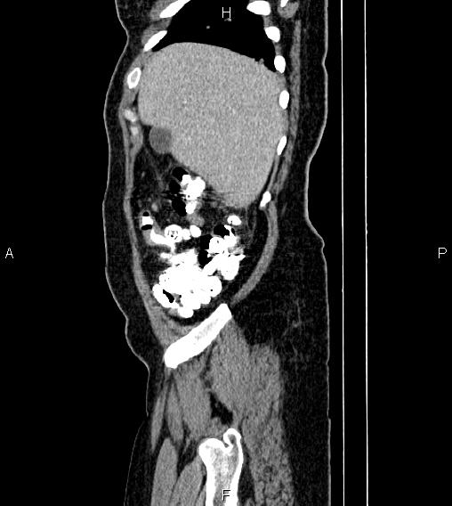 Abdominal lymphoma with sandwich sign (Radiopaedia 84378-99704 Sagittal C+ portal venous phase 6).jpg