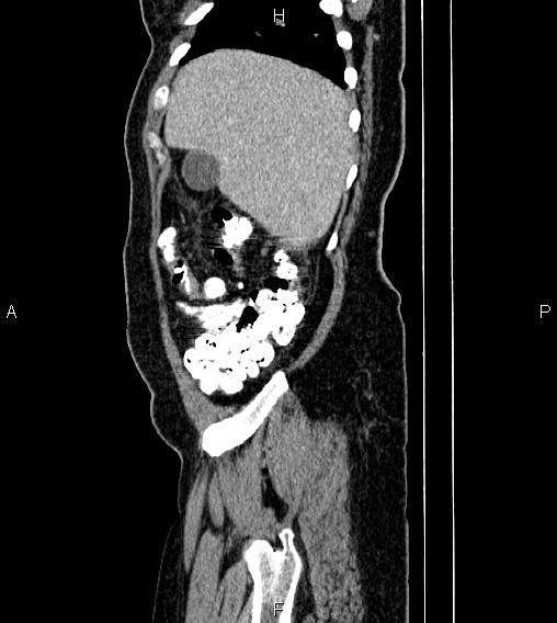 Abdominal lymphoma with sandwich sign (Radiopaedia 84378-99704 Sagittal C+ portal venous phase 7).jpg