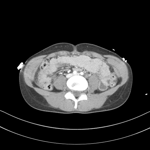 File:Abdominal multi-trauma - devascularised kidney and liver, spleen and pancreatic lacerations (Radiopaedia 34984-36486 Axial C+ portal venous phase 50).png