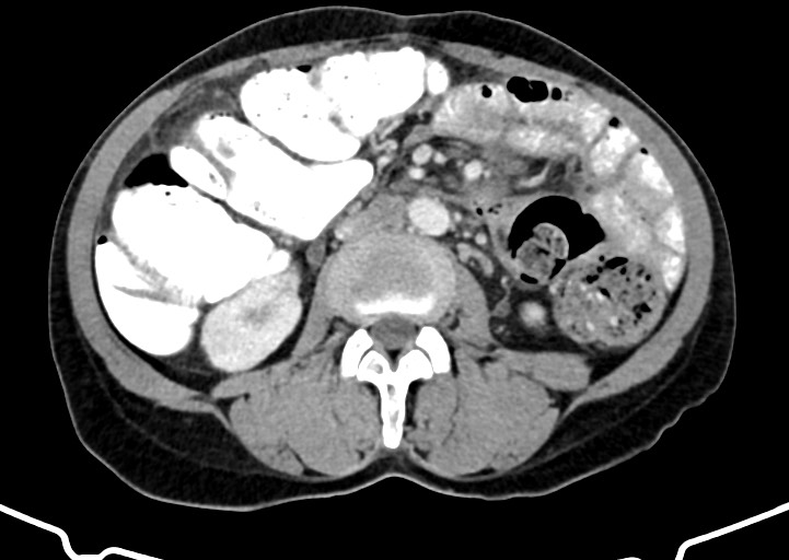 File:Abdominal wall and retroperitoneal tuberculosis (Radiopaedia 88137-104729 Axial C+ portal venous phase 97).jpg