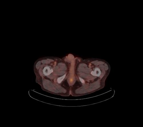 Abdominal wall metastasis from colorectal carcinoma (Radiopaedia 31016-31719 C 13).jpg