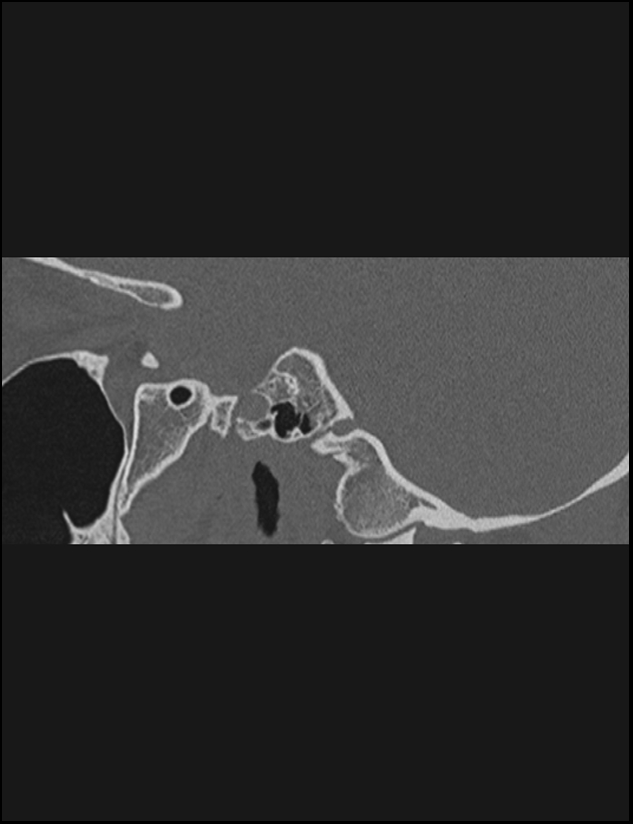 Aberrant right internal carotid artery (Radiopaedia 65191-74198 Sagittal non-contrast 77).jpg