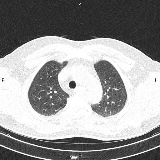 Aberrant right subclavian artery (Radiopaedia 87093-103354 Axial lung window 29).jpg