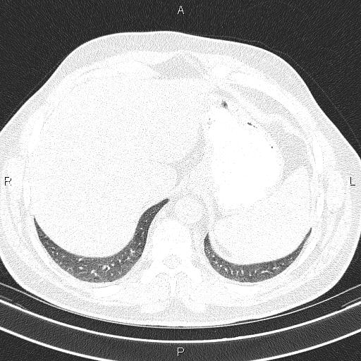 Aberrant right subclavian artery (Radiopaedia 87093-103354 Axial lung window 97).jpg