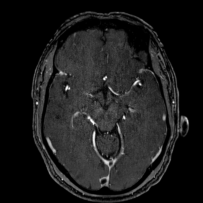 Accessory middle cerebral artery (Radiopaedia 73114-83828 Axial MRA 80).jpg