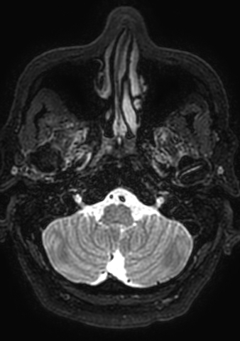 Accessory middle cerebral artery (Radiopaedia 73114-83828 Axial T2 194).jpg
