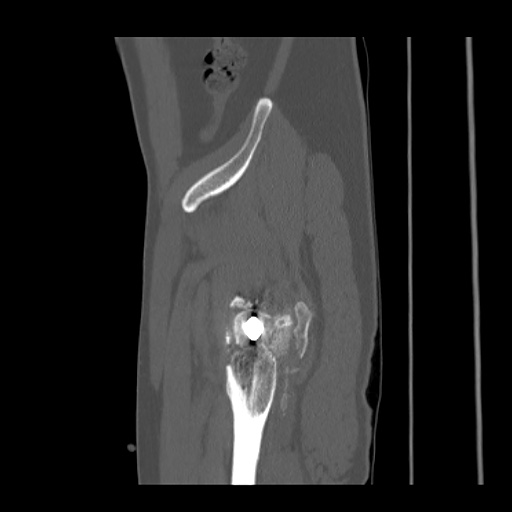 Acetabular and ilial fractures (Radiopaedia 59084-66378 Sagittal bone window 87).jpg