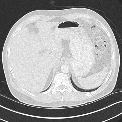 Achalasia of the cardia (Radiopaedia 38497-40595 Axial lung window 49).png