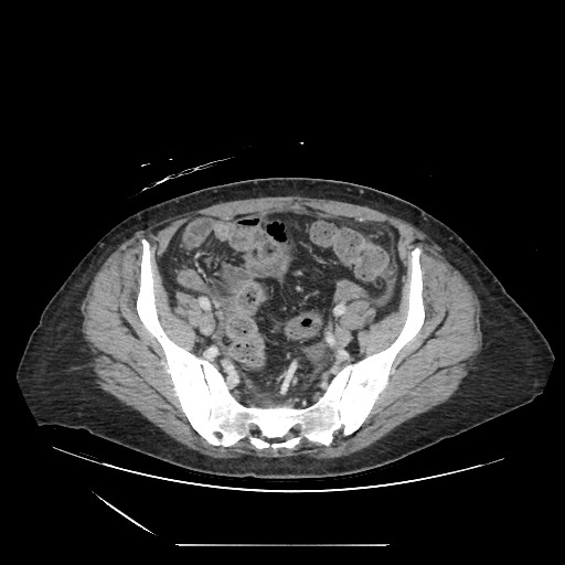 Acinar cell carcinoma of the pancreas (Radiopaedia 75442-86669 Axial C+ portal venous phase 116).jpg