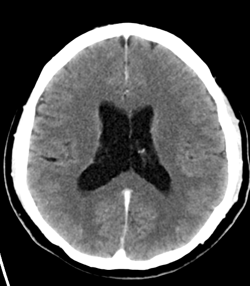 File:Acoustic schwannoma (Radiopaedia 33045-34065 Axial C+ delayed 16).png