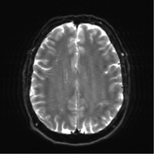 Acoustic schwannoma (Radiopaedia 50846-56358 Axial DWI 20).png