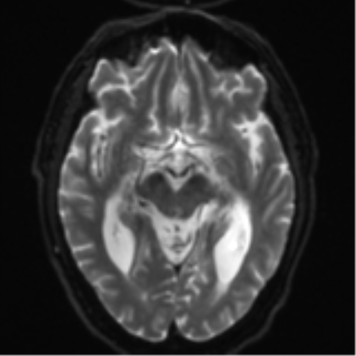 File:Acoustic schwannoma (Radiopaedia 55729-62281 E 11).png