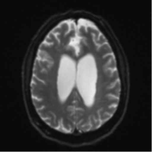 File:Acoustic schwannoma (Radiopaedia 55729-62281 E 19).png