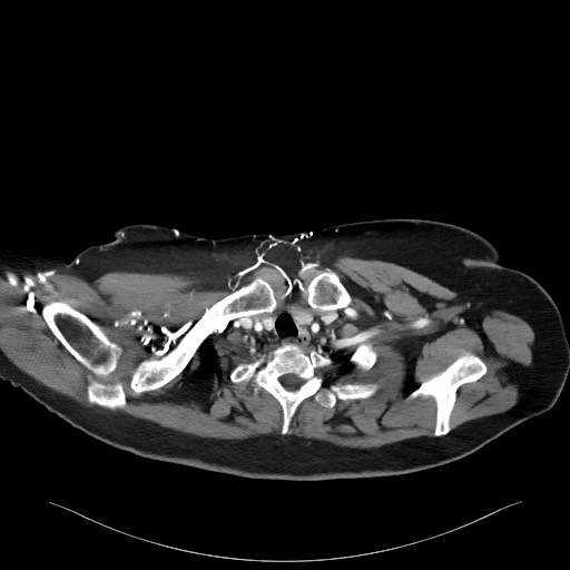 Acromioclavicular joint cyst (Radiopaedia 58455-65610 Axial C+ arterial phase 21).jpg
