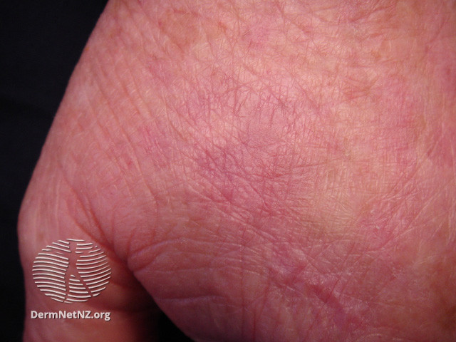File:Actinic Keratoses treated with imiquimod (DermNet NZ lesions-ak-imiquimod-3728).jpg