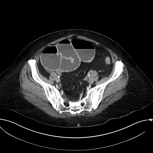 Active Crohn disease (Radiopaedia 59394-66750 Axial C+ portal venous phase 56).jpg