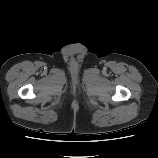 File:Active colonic bleed on CT (Radiopaedia 49765-55025 Axial C+ delayed 93).jpg