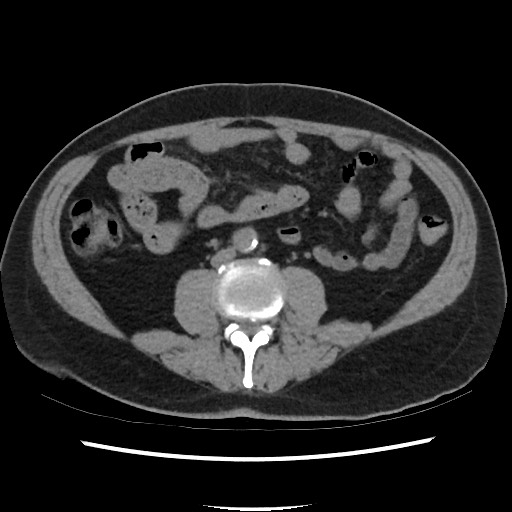 Active colonic bleed on CT (Radiopaedia 49765-55025 Axial non-contrast 44).jpg