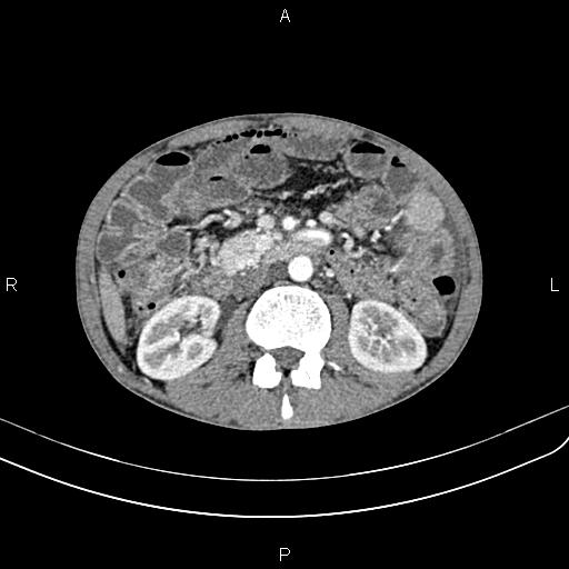 Active crohn disease (Radiopaedia 87133-103397 Axial C+ arterial phase 48).jpg