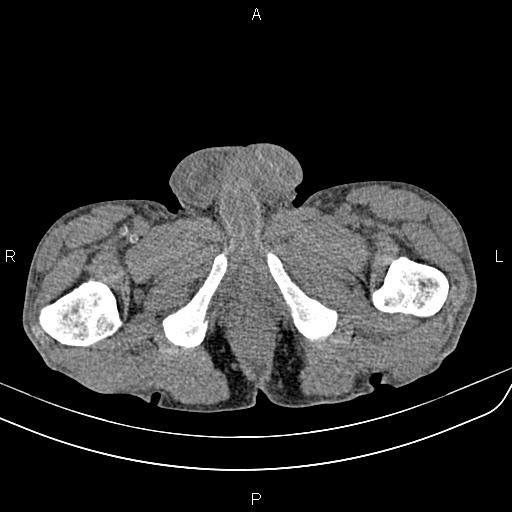 Active crohn disease (Radiopaedia 87133-103397 Axial non-contrast 110).jpg