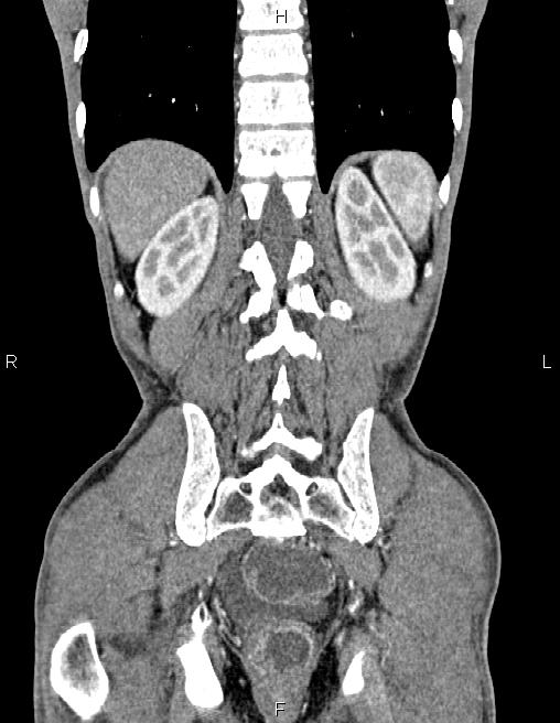 Active crohn disease (Radiopaedia 87133-103397 Coronal C+ arterial phase 53).jpg