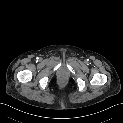 Active lower gastrointestinal bleeding - diverticular (Radiopaedia 61203-69106 Axial C+ arterial phase 97).jpg
