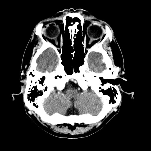 File:Active neurocysticercosis before and after therapy (Radiopaedia 71710-82099 Axial C+ delayed 85).jpg