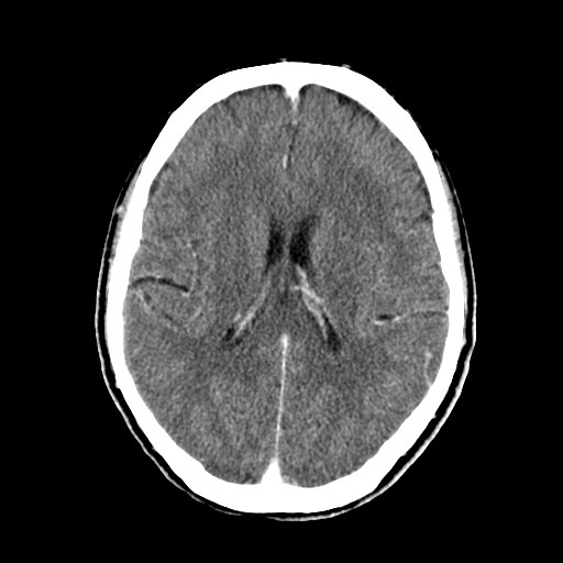 File:Active neurocysticercosis before and after therapy (Radiopaedia 71710-82100 Axial C+ delayed 55).jpg