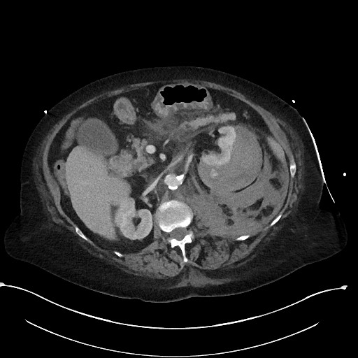 File:Active renal extravasation with large subcapsular and retroperitoneal hemorrhage (Radiopaedia 60975-68796 Axial 273).jpg