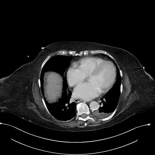 File:Active renal extravasation with large subcapsular and retroperitoneal hemorrhage (Radiopaedia 60975-68796 Axial 357).jpg