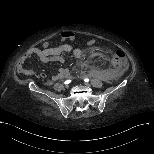 Active renal extravasation with large subcapsular and retroperitoneal hemorrhage (Radiopaedia 60975-68796 Axial C+ arterial phase 132).jpg