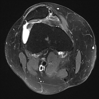 File:Acute-on-chronic transient lateral patellar dislocation with trochlear dysplasia (Radiopaedia 84099-99349 Axial PD fat sat 10).jpg
