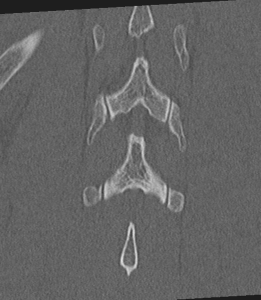 Acute L1 burst compression fracture (Radiopaedia 34430-35755 Coronal bone window 50).png
