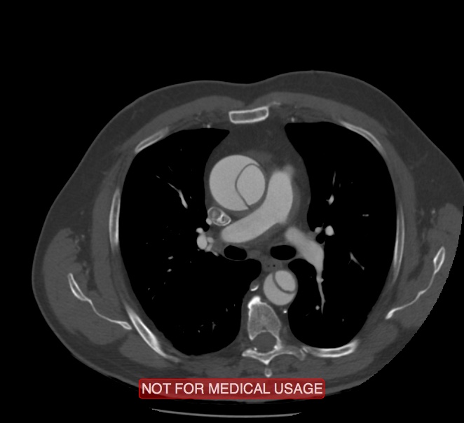Acute aortic dissection - Stanford type A (Radiopaedia 40661-43285 Axial C+ arterial phase 23).jpg