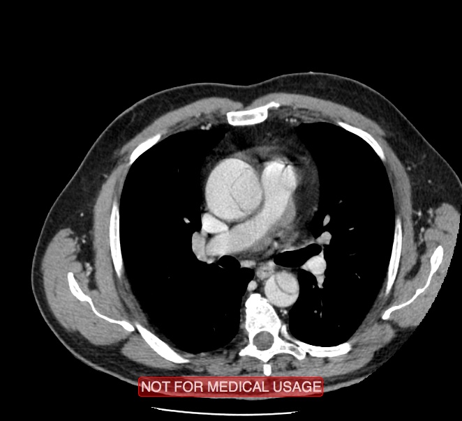 Acute aortic dissection - Stanford type A (Radiopaedia 40661-43285 Axial C+ portal venous phase 21).jpg