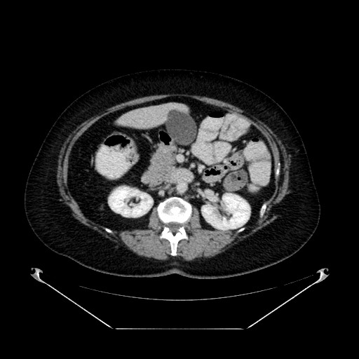 File:Acute appendicitis, heterotaxy syndrome (Radiopaedia 66884-76202 Axial 53).jpg
