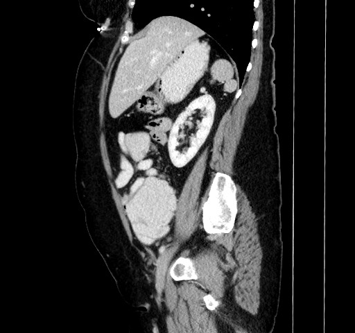 Acute appendicitis, heterotaxy syndrome (Radiopaedia 66884-76202 Sagittal C+ portal venous phase 49).jpg