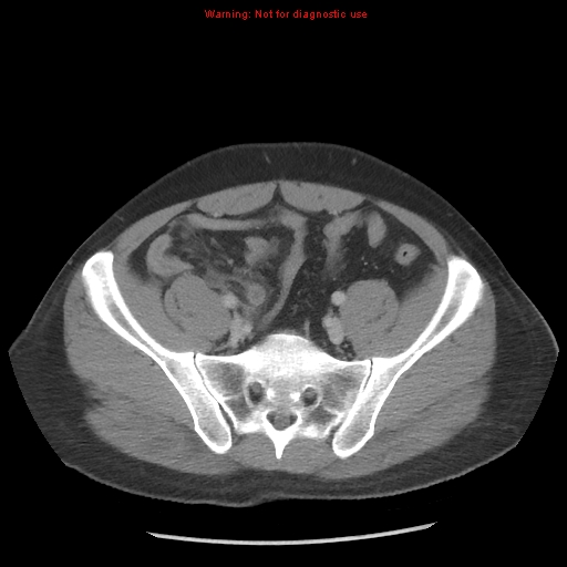 Acute appendicitis (Radiopaedia 10498-10973 Axial C+ portal venous phase 33).jpg