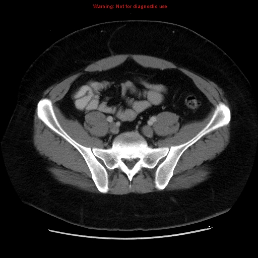 File:Acute appendicitis (Radiopaedia 12326-12607 Axial C+ portal venous phase 36).jpg