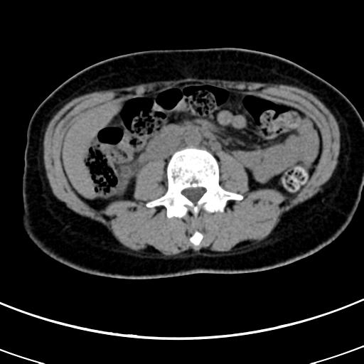 Acute appendicitis (Radiopaedia 30261-30888 Axial non-contrast 38).jpg