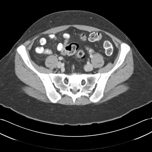 Acute appendicitis (Radiopaedia 30297-30934 Axial C+ portal venous phase 61).jpg