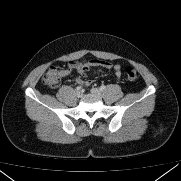 File:Acute appendicitis (Radiopaedia 38255-40270 Axial C+ portal venous phase 77).jpg