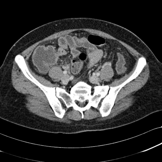 File:Acute appendicitis (Radiopaedia 48792-53822 Axial C+ portal venous phase 84).jpg