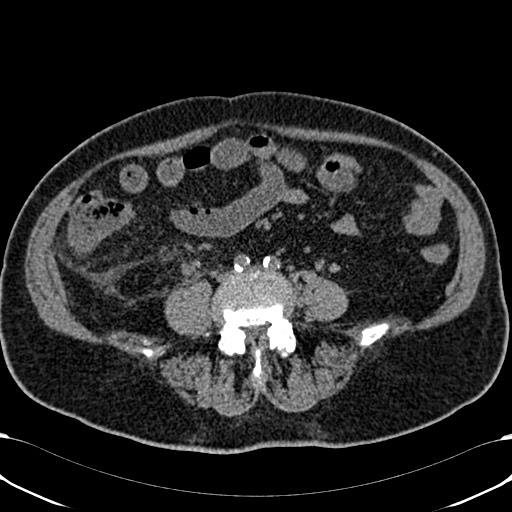 Acute appendicitis (Radiopaedia 58627-65818 Axial non-contrast 55).jpg