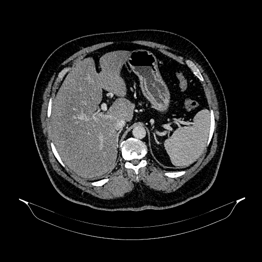 Acute appendicitis (Radiopaedia 79950-93224 Axial C+ portal venous phase 27).jpg