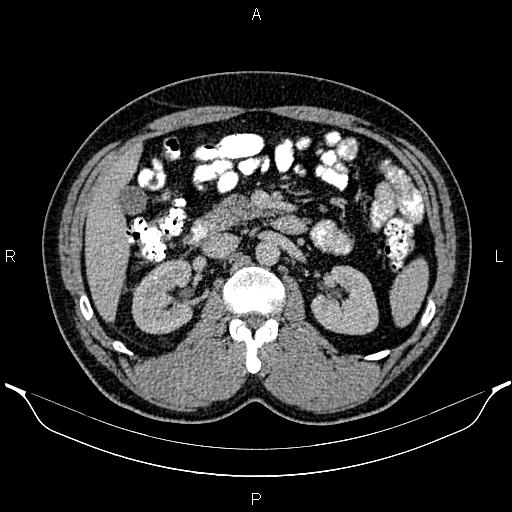 Acute appendicitis (Radiopaedia 84780-100240 Axial C+ portal venous phase 42).jpg