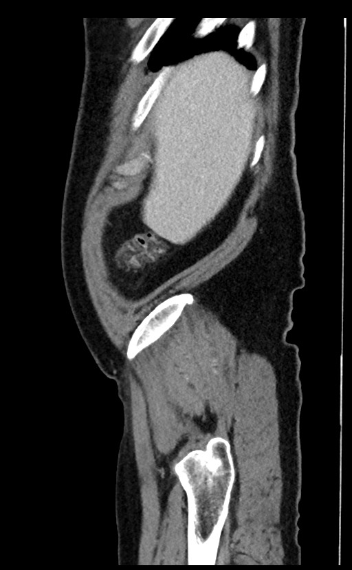 Acute appendicitis - large appendicoliths (Radiopaedia 61805-69820 Sagittal C+ portal venous phase 103).jpg