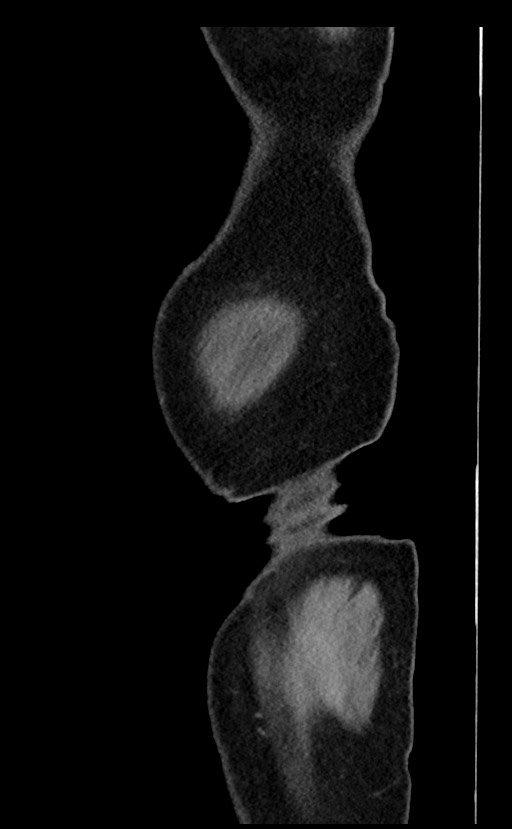 Acute appendicitis - large appendicoliths (Radiopaedia 61805-69820 Sagittal C+ portal venous phase 114).jpg