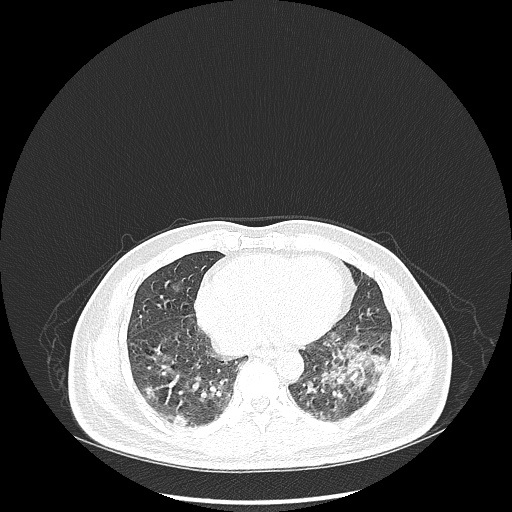 Acute appendicitis and COVID 19 pneumonia (Radiopaedia 76604-88380 Axial lung window 38).jpg